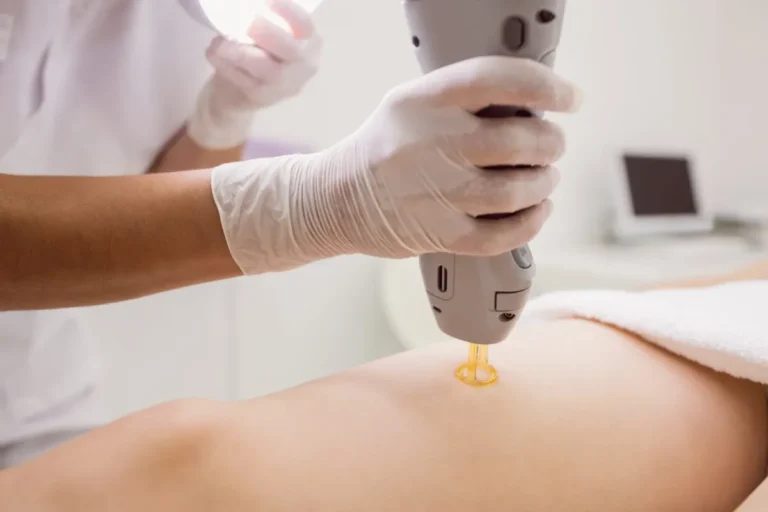 laser hair removal