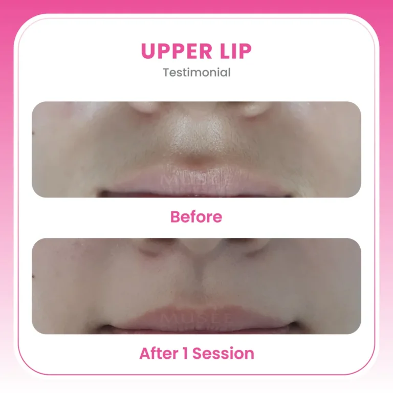 upper lip