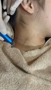 eczema treatment malaysia