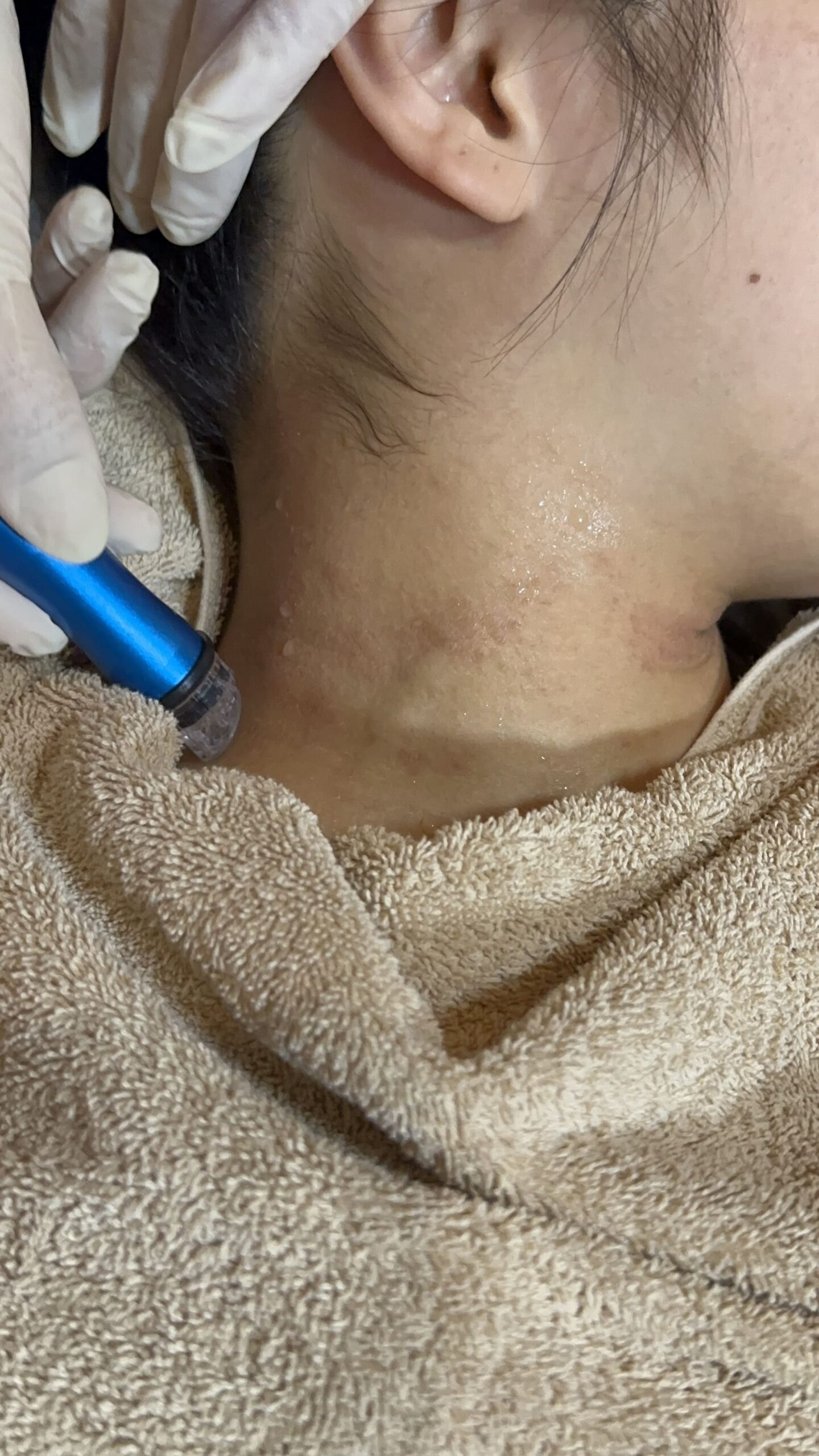 eczema treatment malaysia