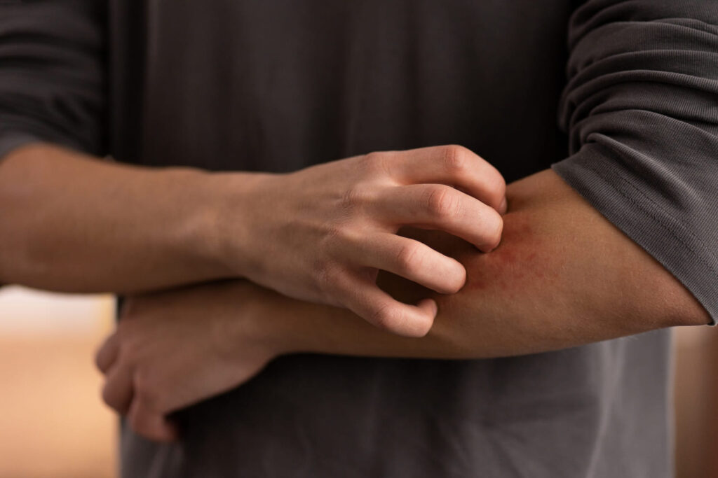 best eczema treatment