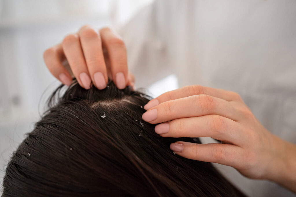 dandruff treatment
