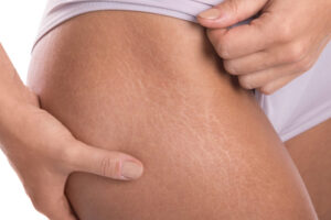 stretch mark treatment
