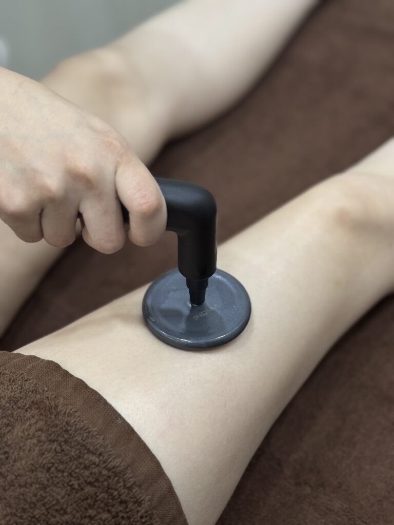 stretch mark treatment in Malaysia
