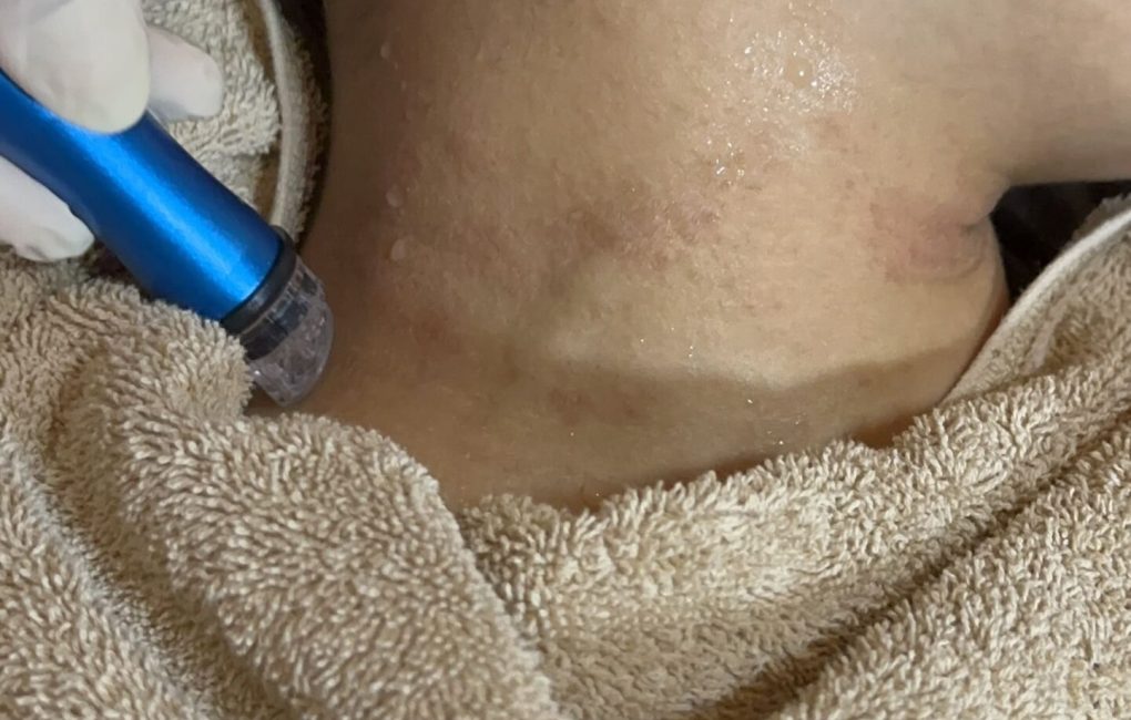 eczema treatment malaysia