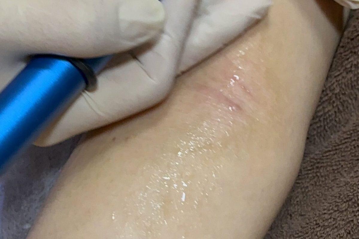 hand eczema treatment